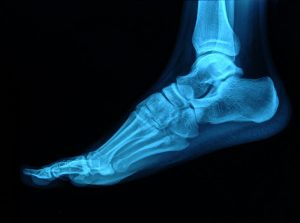 foot x-ray