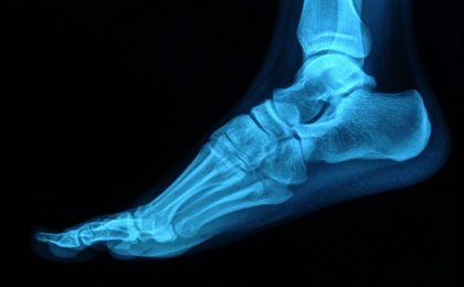 foot x-ray